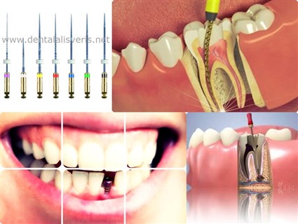 Kanal Tedavisi & Endodonti